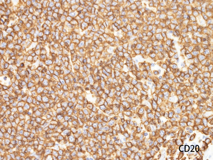 CD20-2.jpg