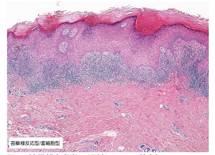lichenoid type.jpg