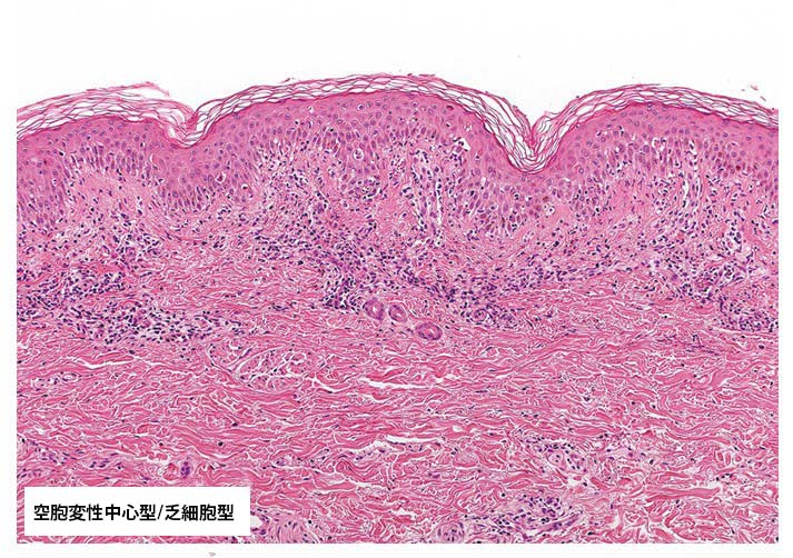 vacuolar type.jpg