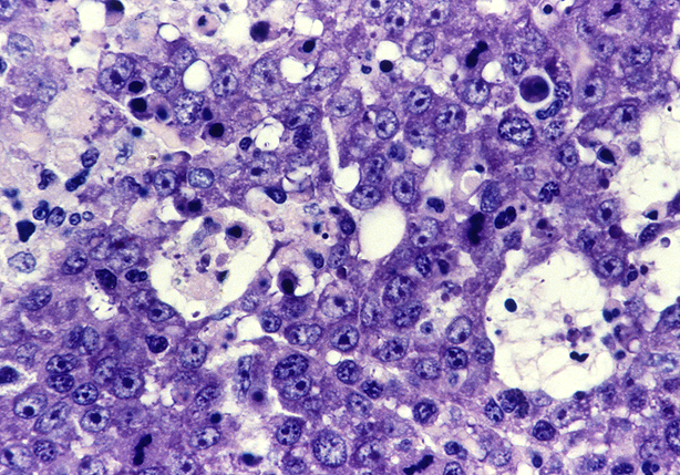 AML-M5a1-160Giemsa.png